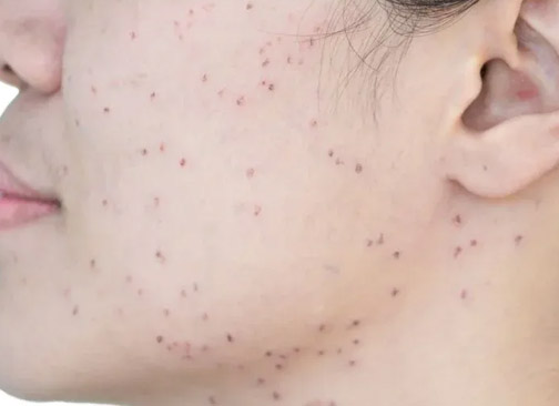 Dark Spots